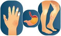 Scleroderma can lead to painful bumps under the skin, red spots, patches of hard skin, and even digestive problems.